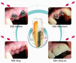 quá trình trồng răng Implant