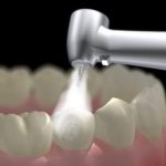 Trám răng thẩm mỹ ngăn ngừa bệnh nha hiệu quả
