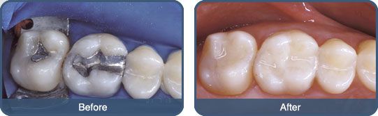 Trám răng thẩm mỹ ngăn ngừa bệnh nha hiệu quả