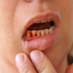 chảy máu chân răng thường xuyên