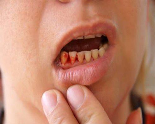 chảy máu chân răng thường xuyên