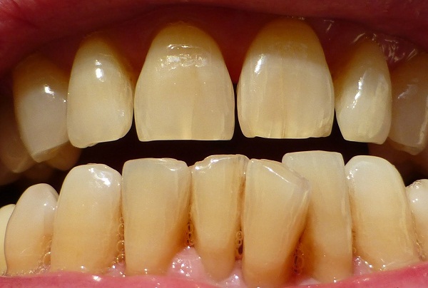 răng vàng có tẩy trắng được không