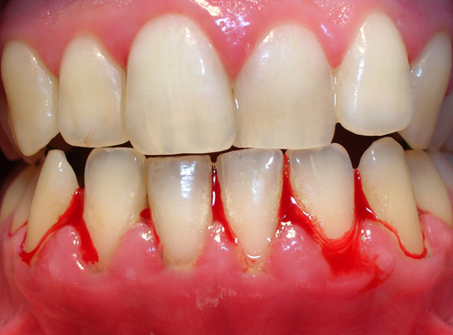 Chảy máu răng nên làm gì để khắc phục? 1