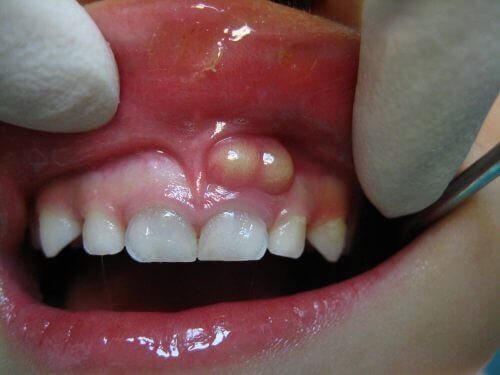 Viêm chân răng có mủ có nguy hiểm không? 1