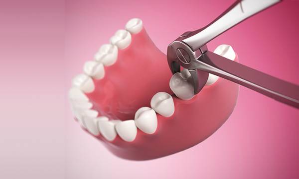 Nhổ răng khôn không đau bằng phương pháp nào? 3