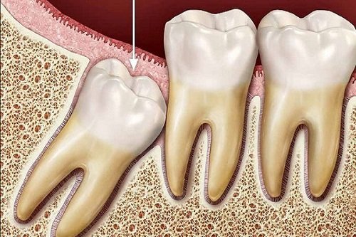 Những điều cần biết về răng khôn 1