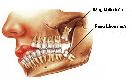 Răng khôn hàm dưới mọc lệch có sao không? 1