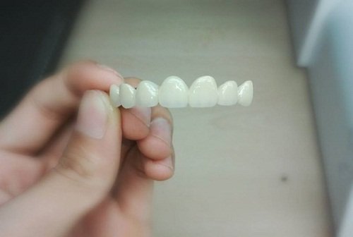 Trồng răng khểnh ở đâu hiệu quả và an toàn? 2