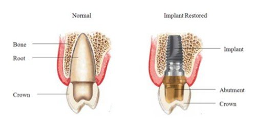 Các loại trụ Implant tại nha khoa hiện nay 1