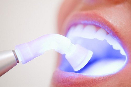 Các phương pháp tẩy trắng răng hiện nay 2