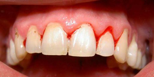 Viêm chân răng ở bà bầu có nên đi lấy cao răng không? 1