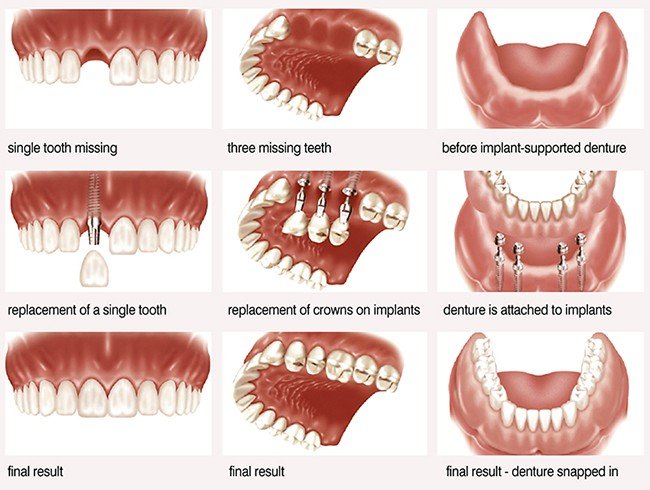 Làm răng Implant phục hình lại răng đã mất 3