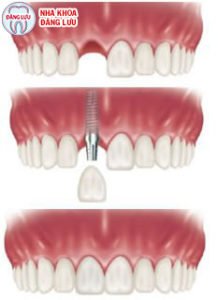 Quy trình thực hiện Implant răng cửa 1