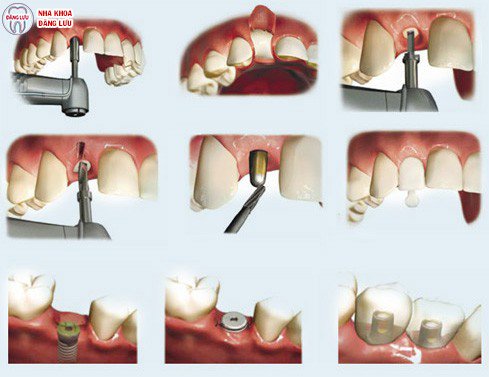 Trồng răng Implant giá bao nhiêu? 1