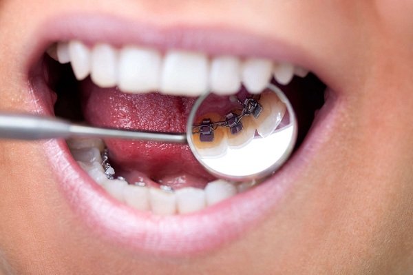 Chi phí niềng răng có đắt không? 1