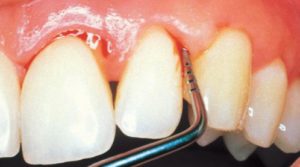 Dấu hiệu viêm chân răng bạn nên phòng ngừa sớm 1