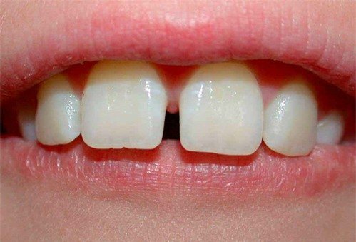 Dịch vụ làm răng sứ hiệu quả và uy tín 1