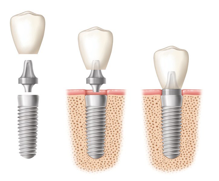 Giá làm răng sứ Implant là bao nhiêu? 1