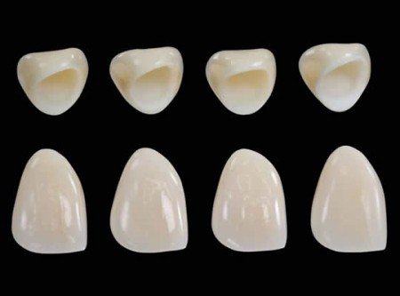 Độ bền của răng sứ thẩm mỹ 1