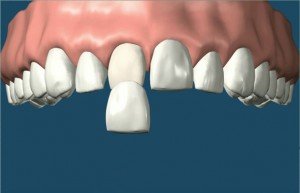 Quy trình và ưu điểm của làm răng sứ Veneer 1