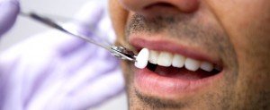 Quy trình và ưu điểm của làm răng sứ Veneer 2