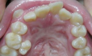 Ưu điểm của kỹ thuật nhổ răng hàm không đau 1