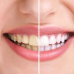 Những cách làm trắng răng tại nha khoa hiện nay