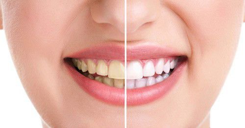 Những cách làm trắng răng tại nha khoa hiện nay