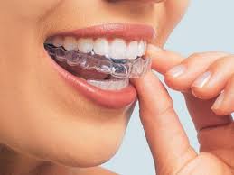 Niềng răng bằng nhựa là gì? 2