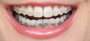 Niềng răng có ảnh hưởng gì không? 1