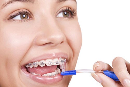 Niềng răng có ảnh hưởng gì không? 2