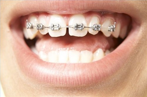 Niềng răng có đau không? Có hại cho sức khoẻ không? 1