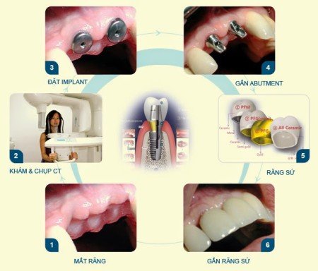 Cấy ghép Implant cho răng cửa thực hiện như thế nào? 3