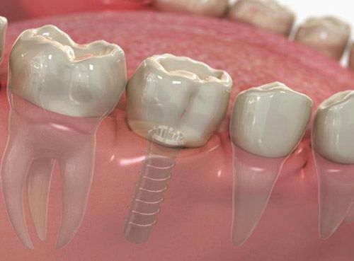 Bảng giá trồng răng Implant 1