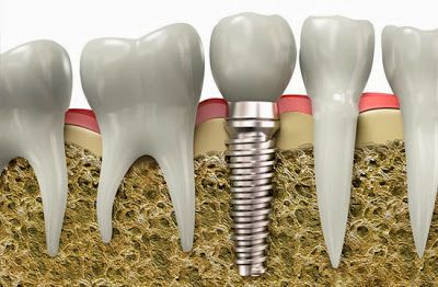 Làm răng Implant phục hình lại răng đã mất 1