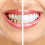 tẩy trắng răng duy trì được trong bao lâu