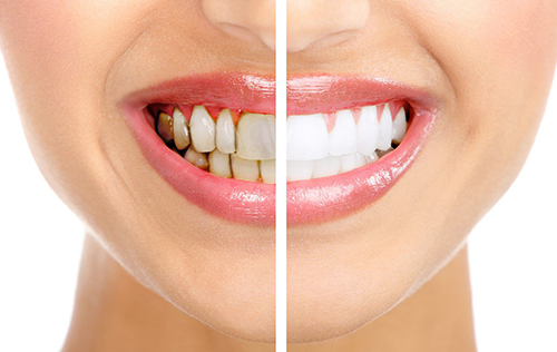 tẩy trắng răng duy trì được trong bao lâu