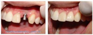 Trồng răng sứ khôi phục vẻ đẹp khuôn miệng của bạn 3