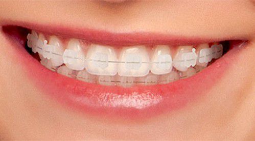 Các phương pháp niềng răng thẩm mỹ hiện nay 1