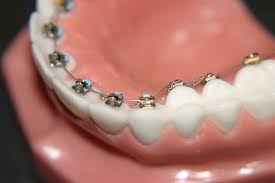 Các phương pháp niềng răng thẩm mỹ hiện nay 3