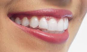 Các phương pháp niềng răng thẩm mỹ hiện nay 2