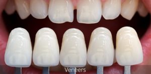 Giá bọc răng sứ Veneer 2