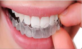 Kỹ thuật niềng răng không nhổ răng 1