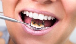 Những điều bạn cần biết về niềng răng mắc cài tự đóng 3