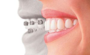 Niềng răng hô khắc phục khuyết điểm hàm răng 2