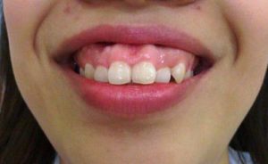 Niềng răng hô khắc phục khuyết điểm hàm răng 1