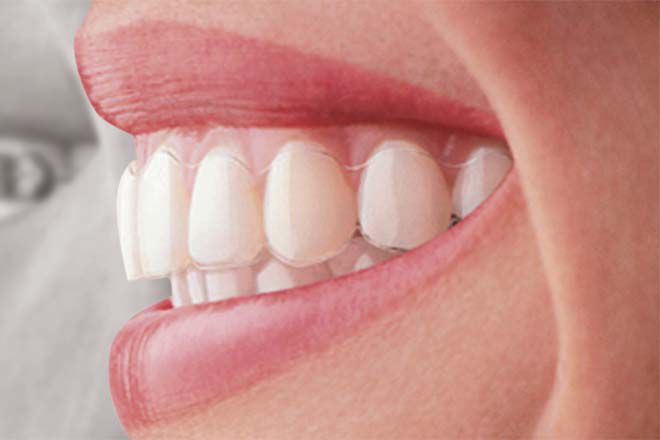 Niềng răng invisalign có những ưu điểm vượt trội nào? 1