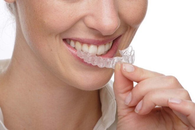 Niềng răng invisalign có những ưu điểm vượt trội nào? 2