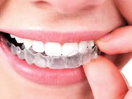 Niềng răng invisalign như thế nào? Hiệu quả không? 1