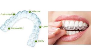 Niềng răng invisalign như thế nào? Hiệu quả không? 2